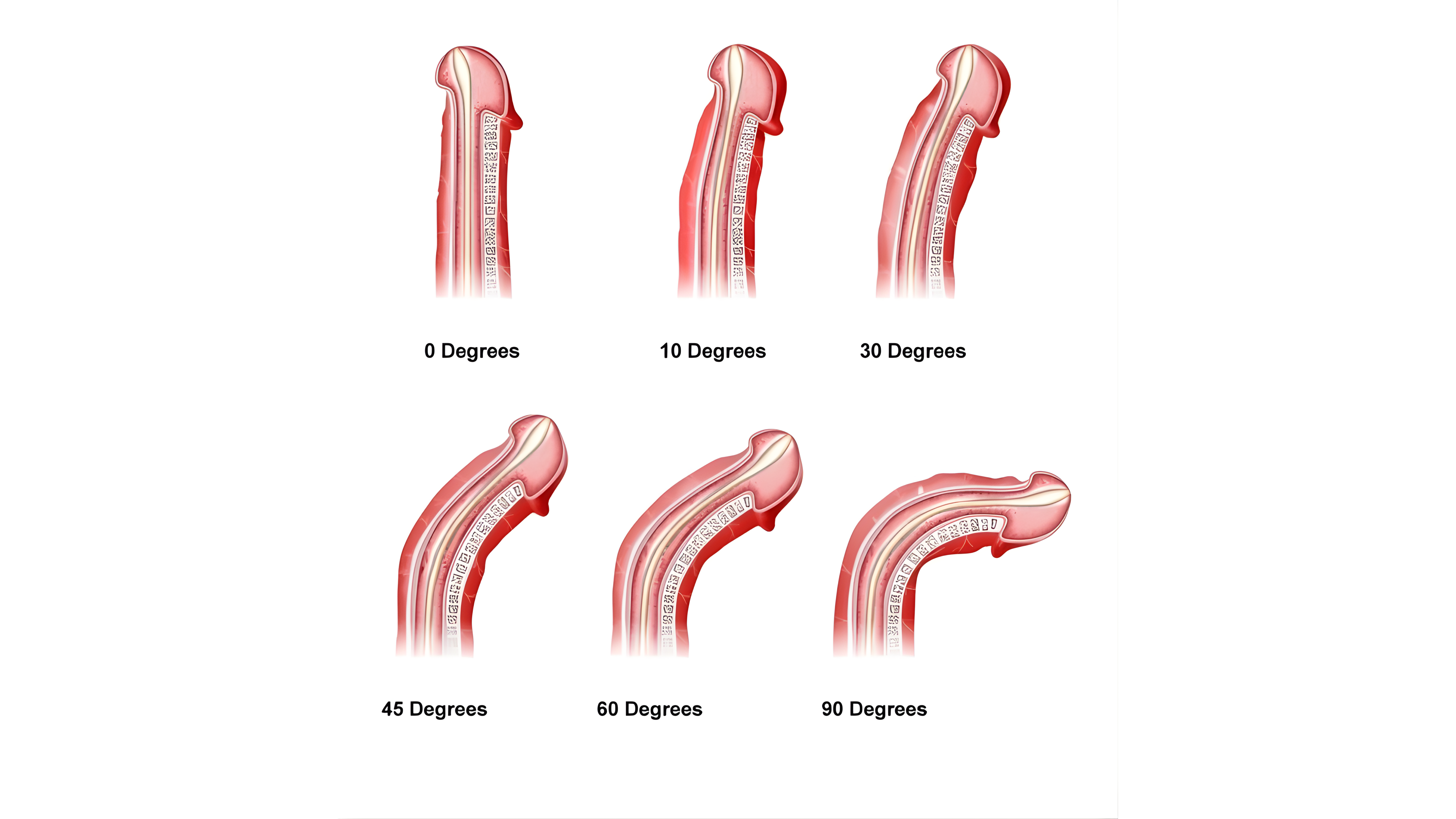 peyronie disease treatment peyronie disease treatment