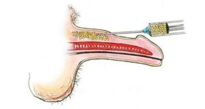 Lipofilling pene: iniezione di grasso autologo