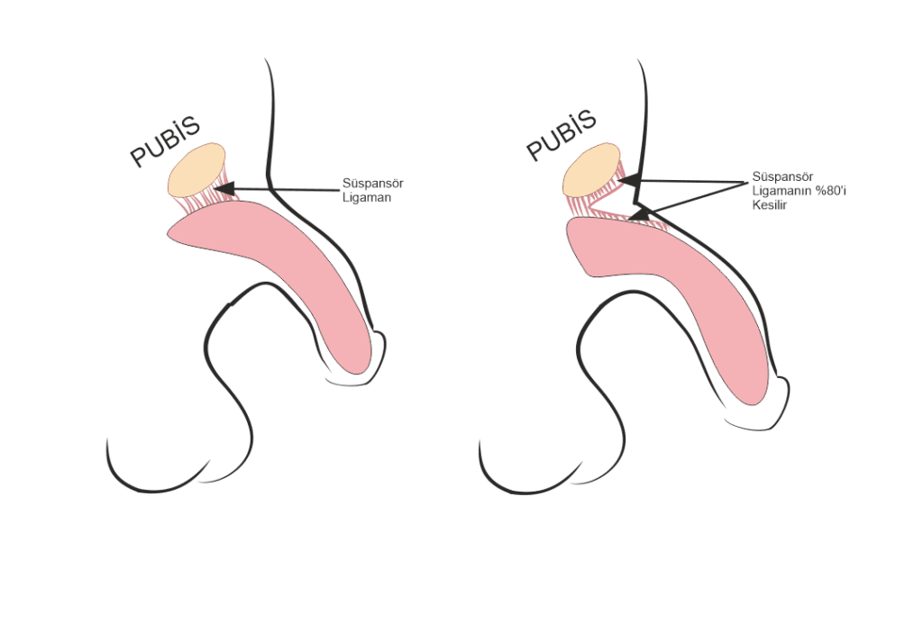 penile lengthening Surgery:
